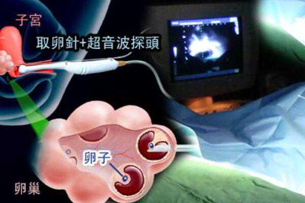武汉寻捐卵志愿者 武汉大学人民医院借卵生子多少钱？ ‘三个月的胎心率可以